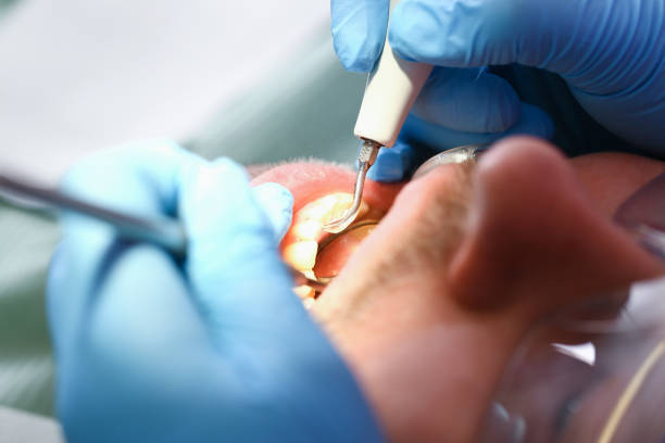 Best Emergency Wisdom Teeth Removal in Bernalillo, NM